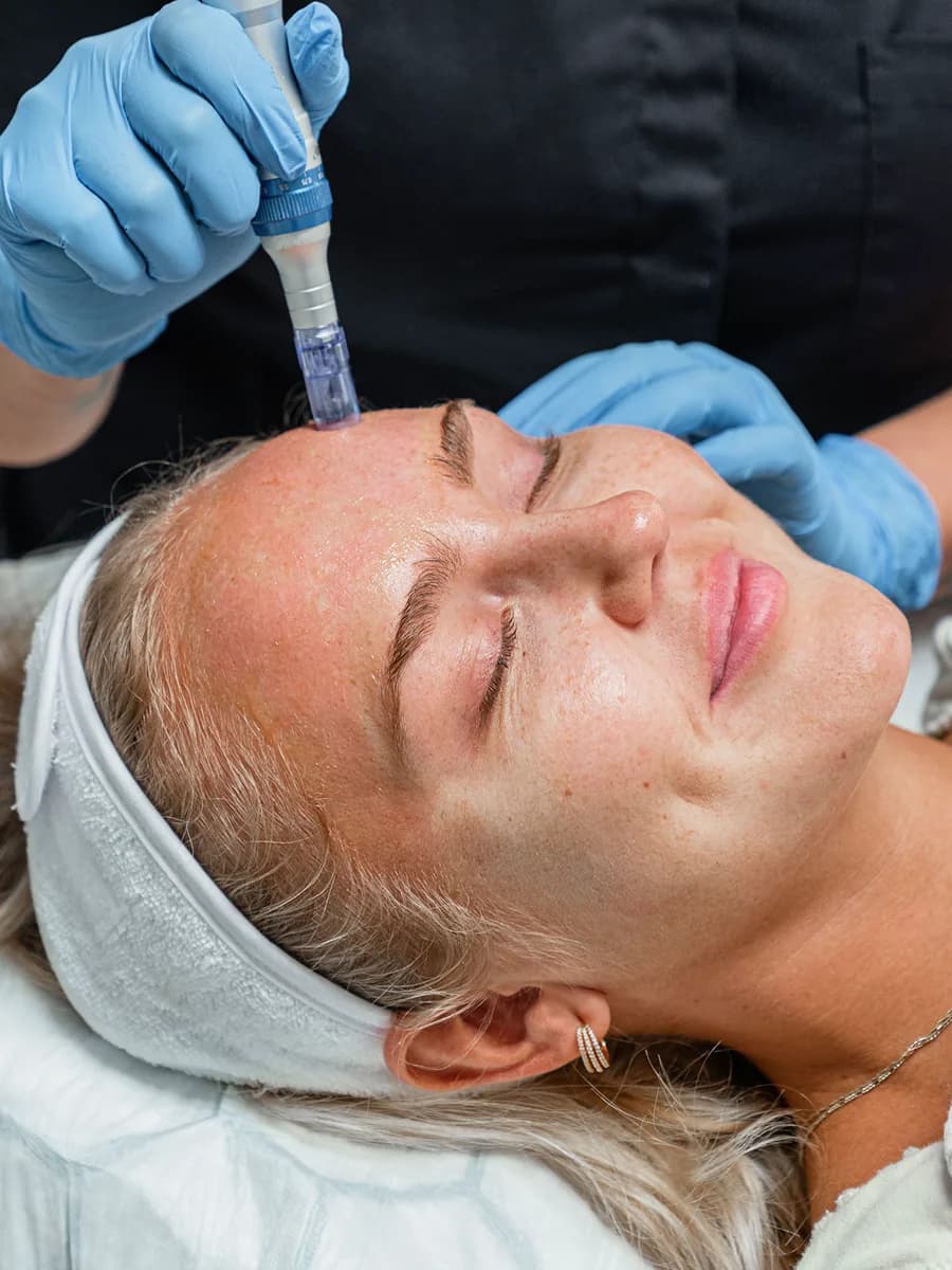 Förnya huden inifrån med Microneedling & PRP