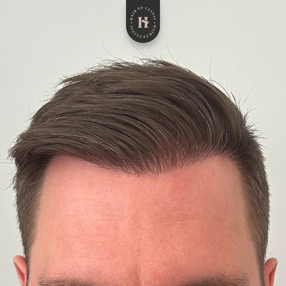 Efter hårtransplantation, 12 månader, återställd hårlinje