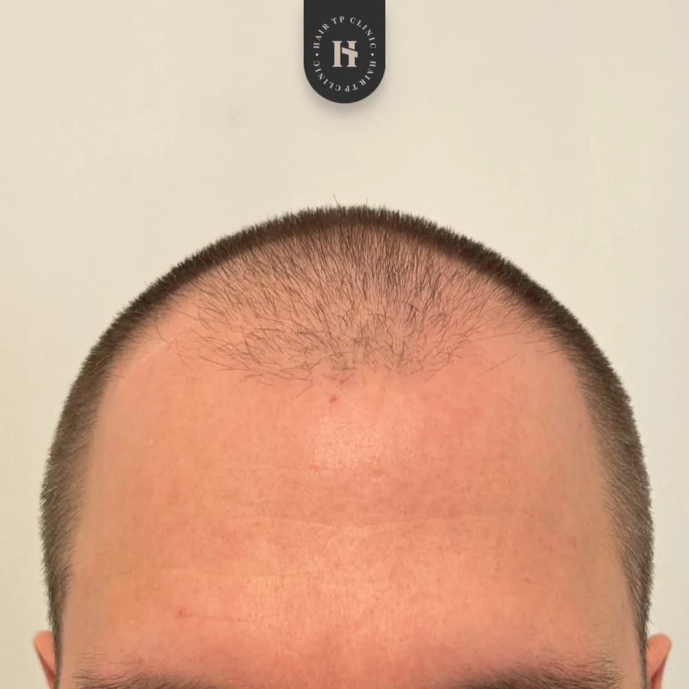 Före hårtransplantation, backande hårlinje