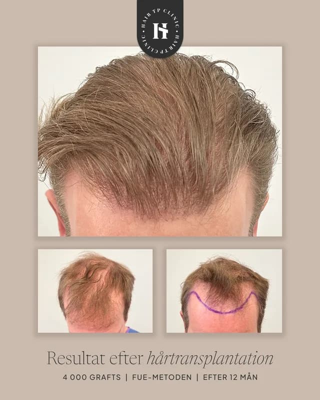 Före & efter, man, resultat 6 av 21