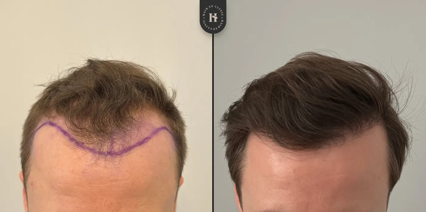 Före & efter, man, resultat 11 av 11