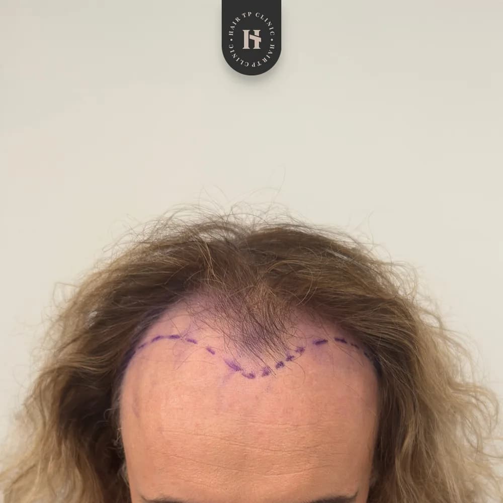 Före hårtransplantation, kvinna