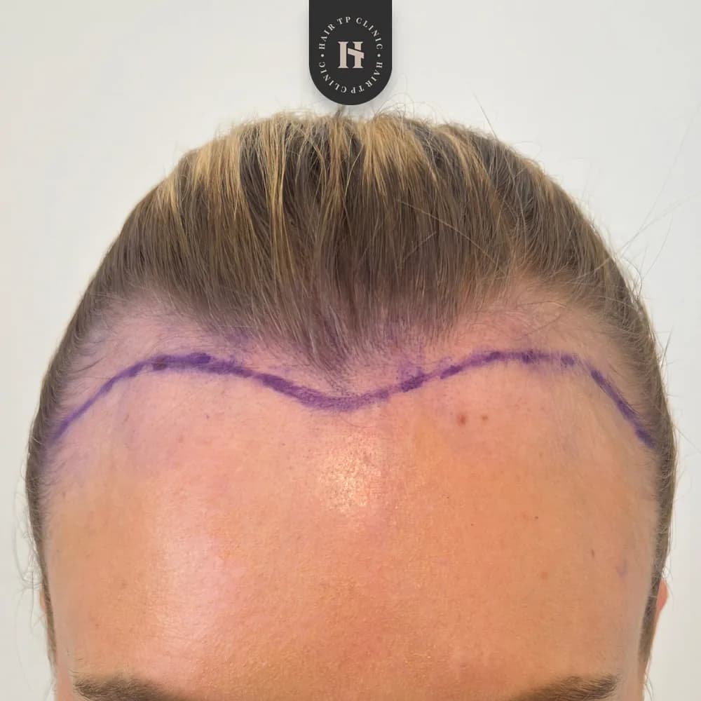 Före hårtransplantation, kvinna