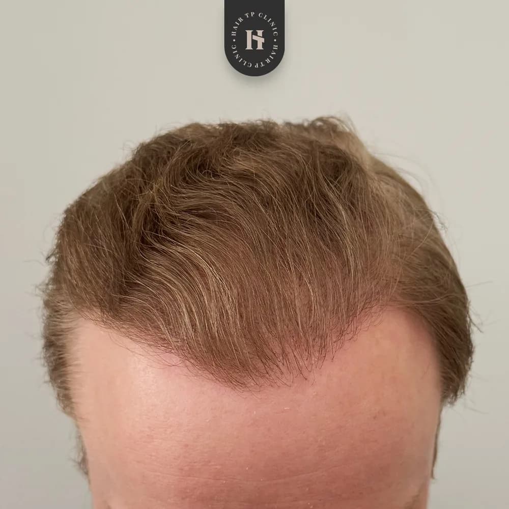 Före och efter hårtransplantation på man, 3 500 grafter med FUE-metoden, resultat efter 12 månader