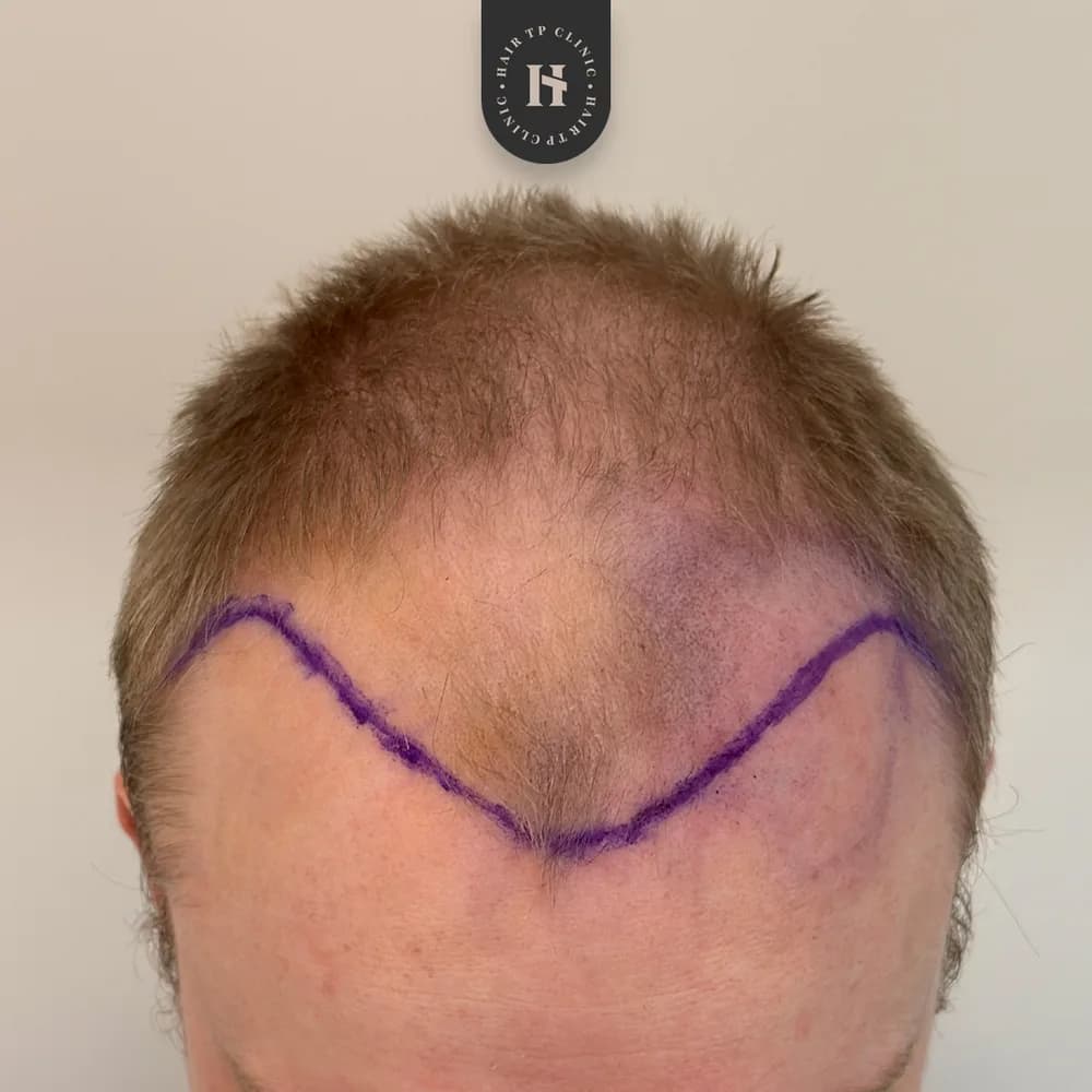 Före hårtransplantation, man