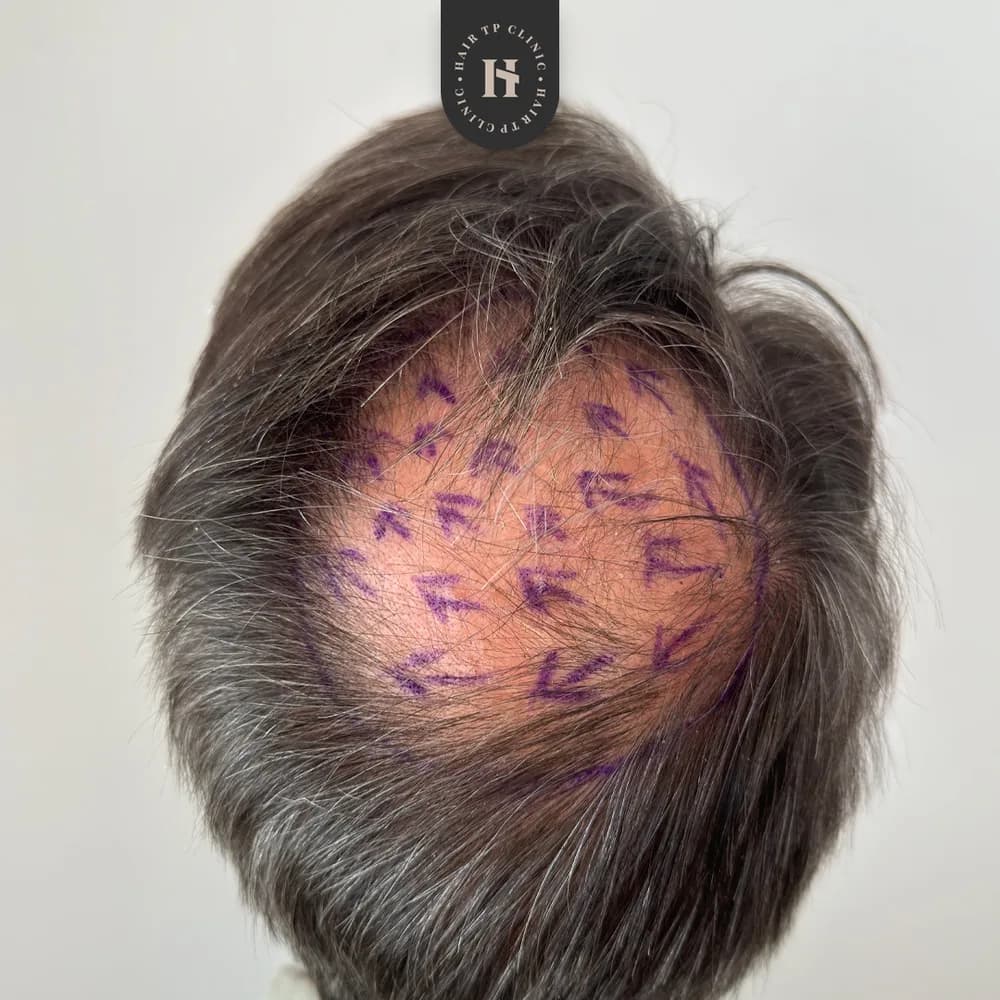 Före hårtransplantation, man