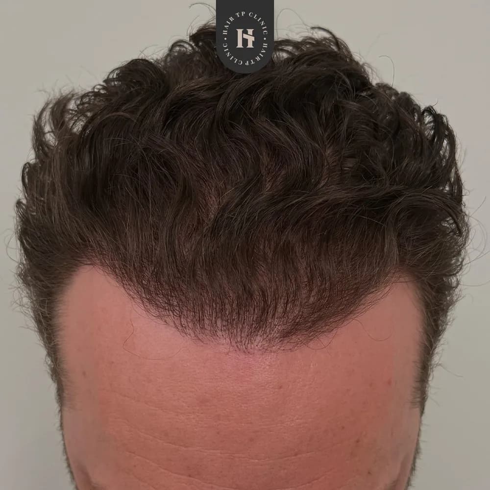 Före och efter hårtransplantation på man, 4 000 grafter med FUE-metoden, resultat efter 12 månader