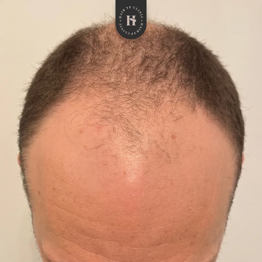 Före hårtransplantation, man