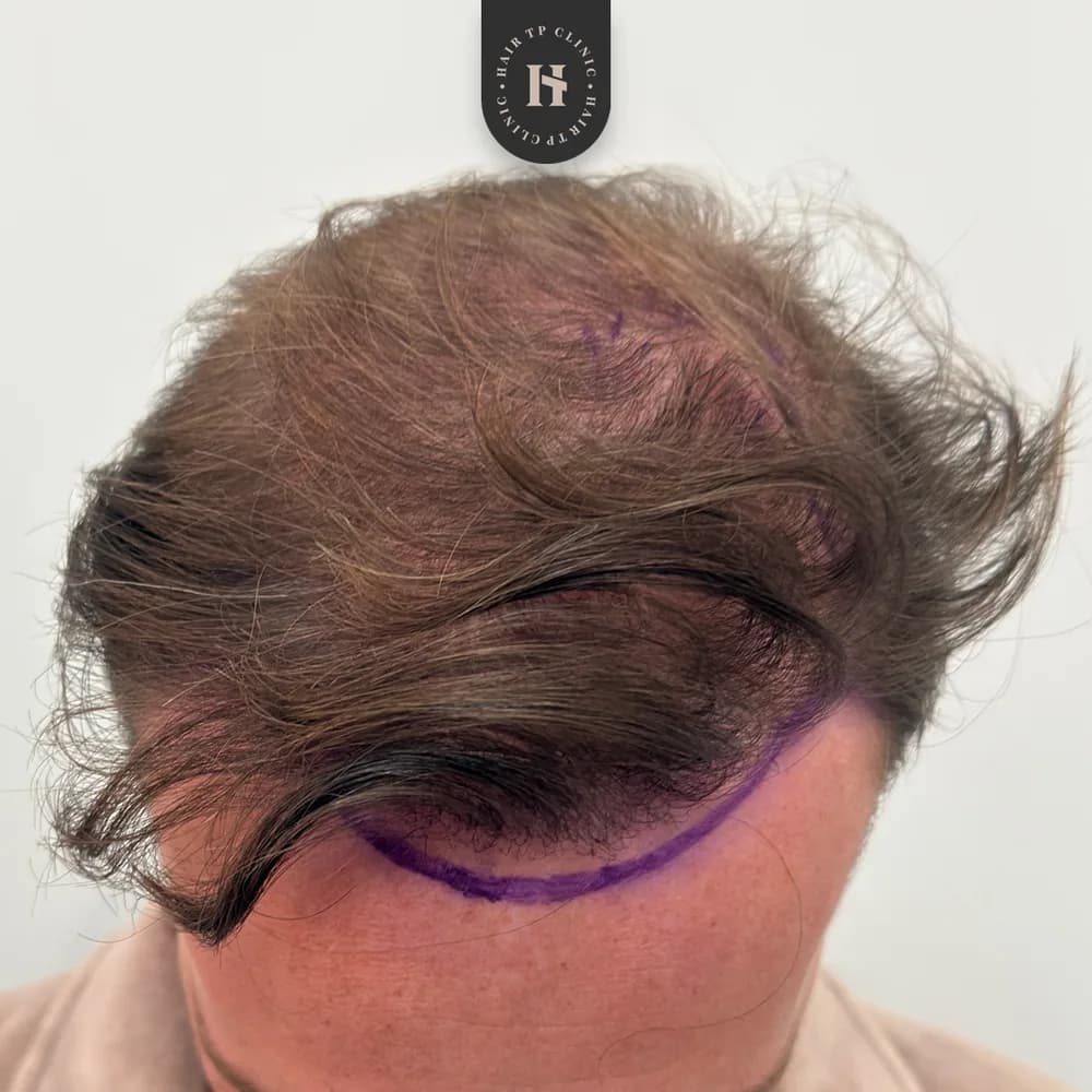 Före och efter hårtransplantation på man, 4 000 grafter med FUE-metoden, resultat efter 12 månader