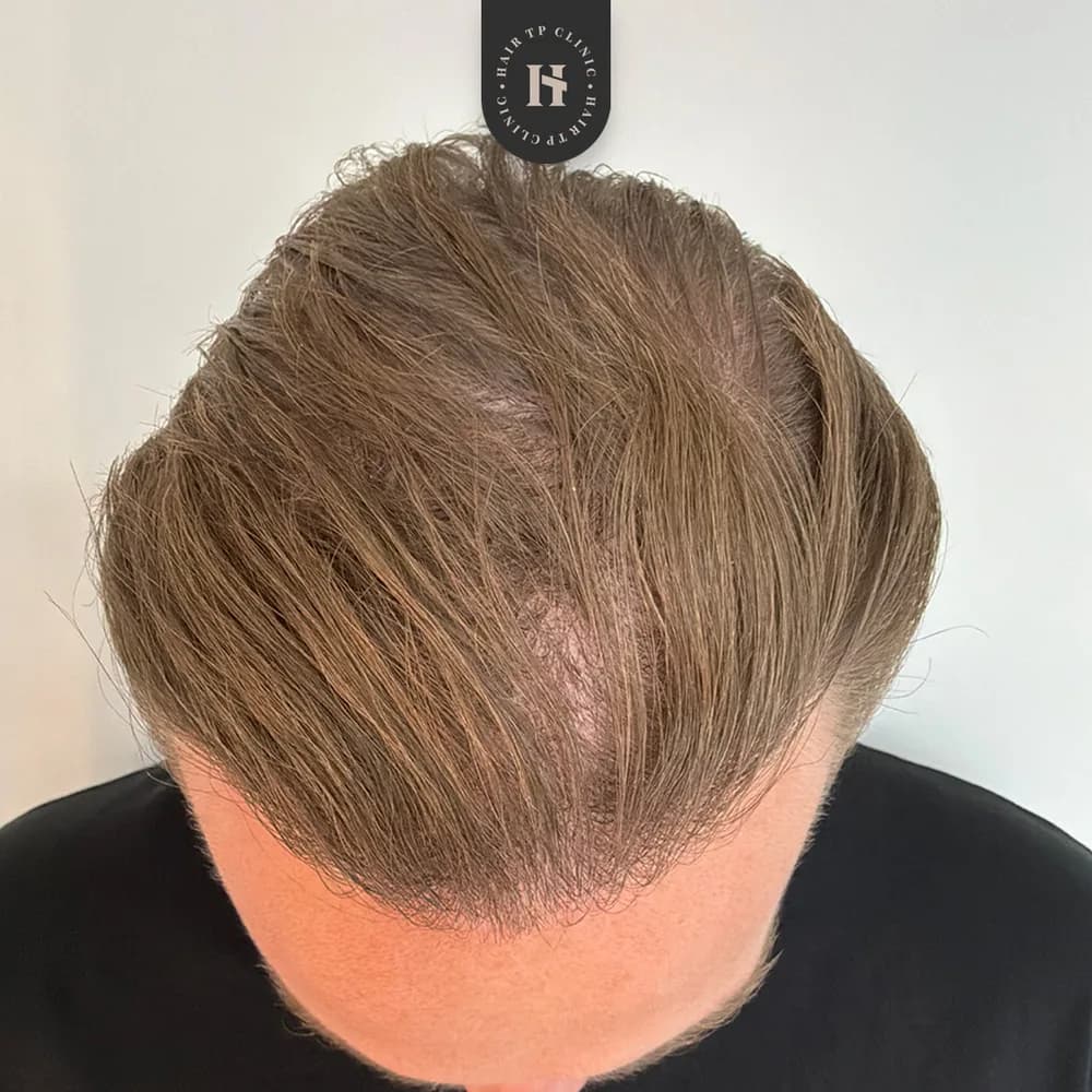 Före hårtransplantation, man