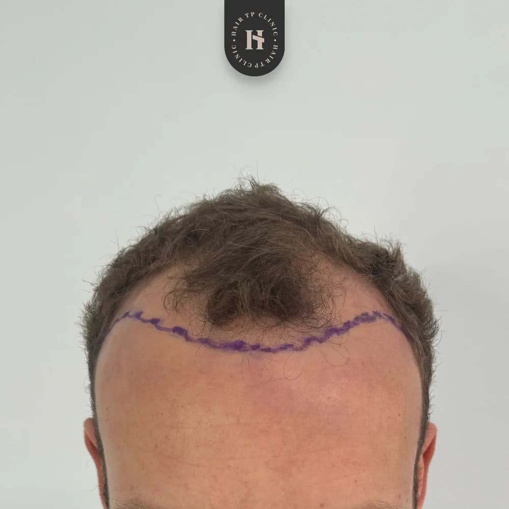 Före och efter hårtransplantation på man, 4 000 grafter med FUE-metoden, resultat efter 12 månader