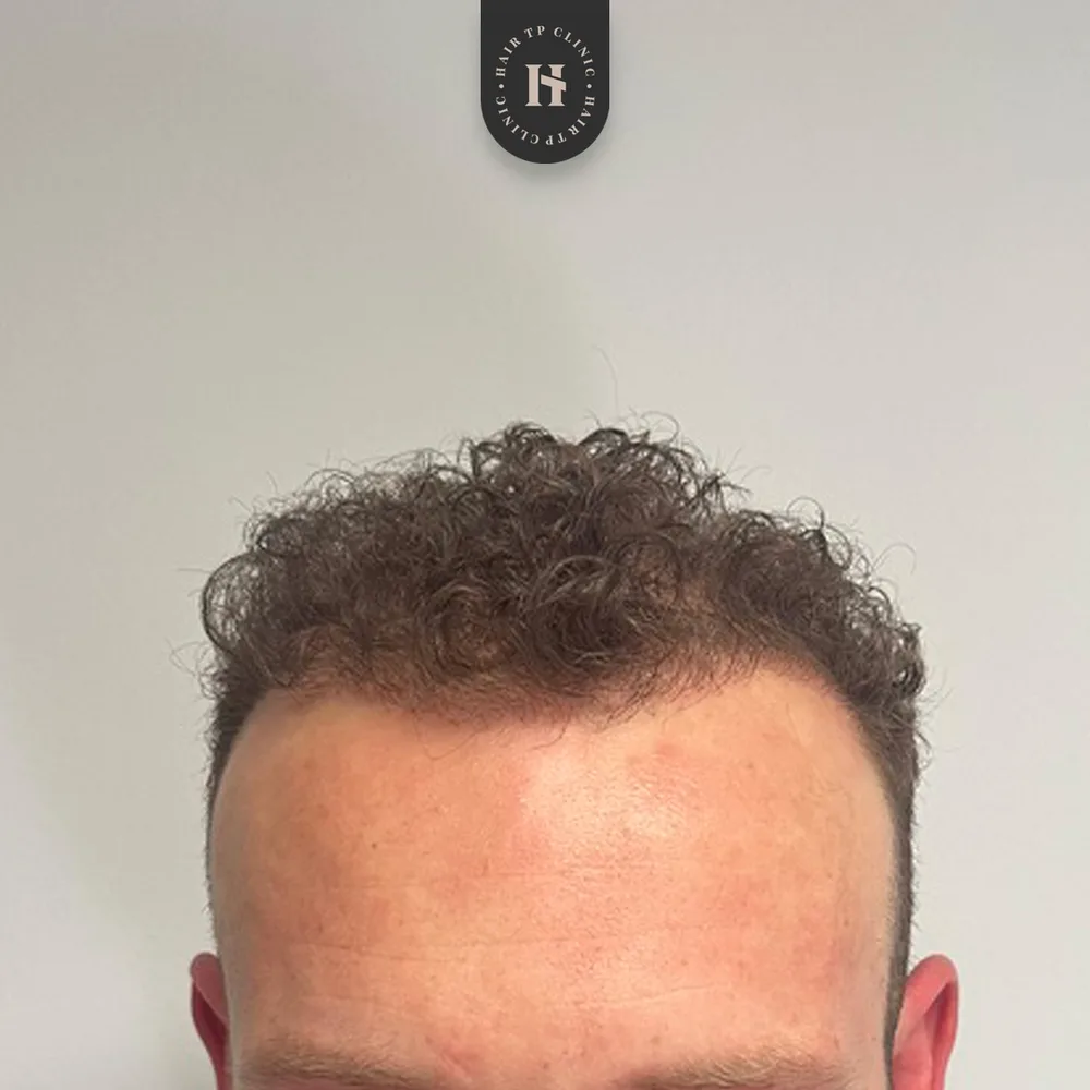 Före hårtransplantation, man