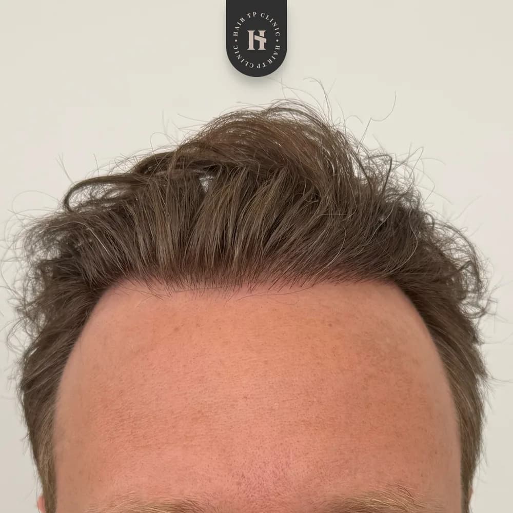 Före och efter hårtransplantation på man, 4 500 grafter med FUE-metoden, resultat efter 12 månader