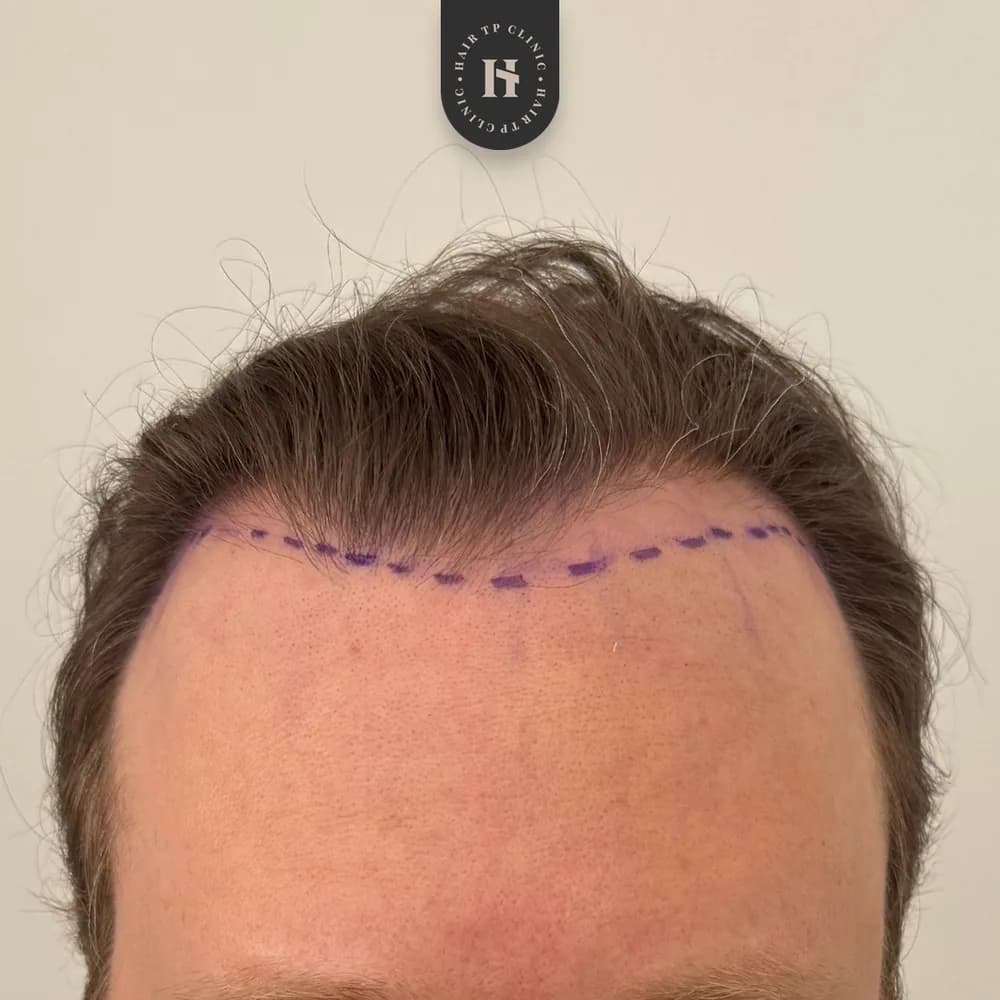 Före hårtransplantation, man