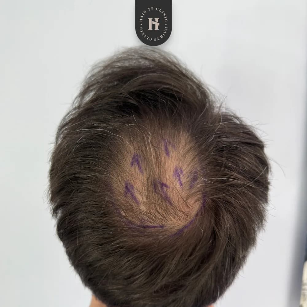 Före hårtransplantation, man
