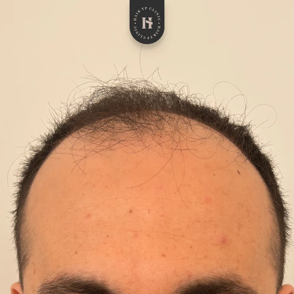 Före hårtransplantation, man