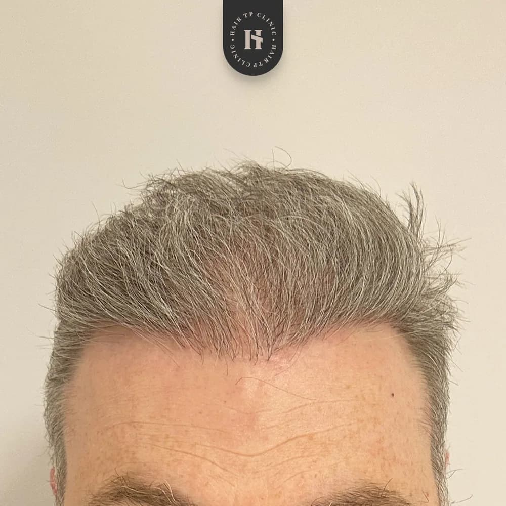 Före och efter hårtransplantation på man, 4 500 grafter med FUE-metoden, resultat efter 12 månader