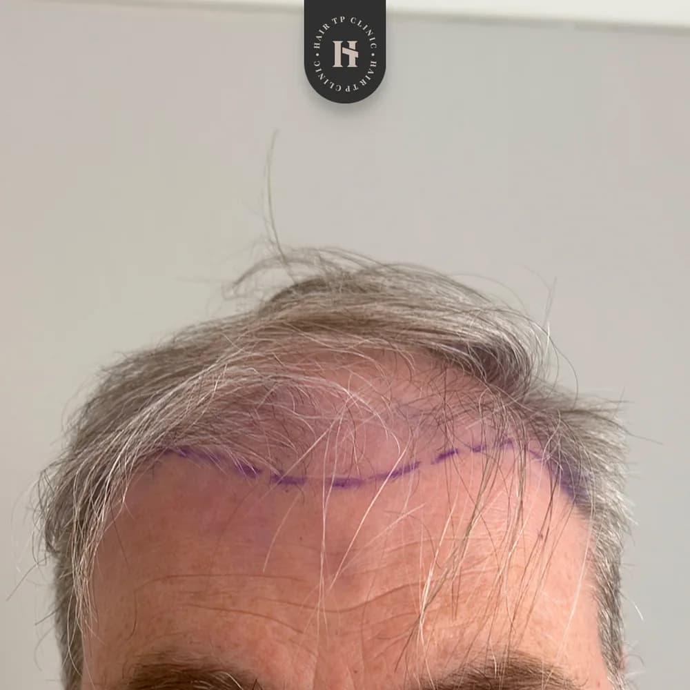 Före hårtransplantation, man