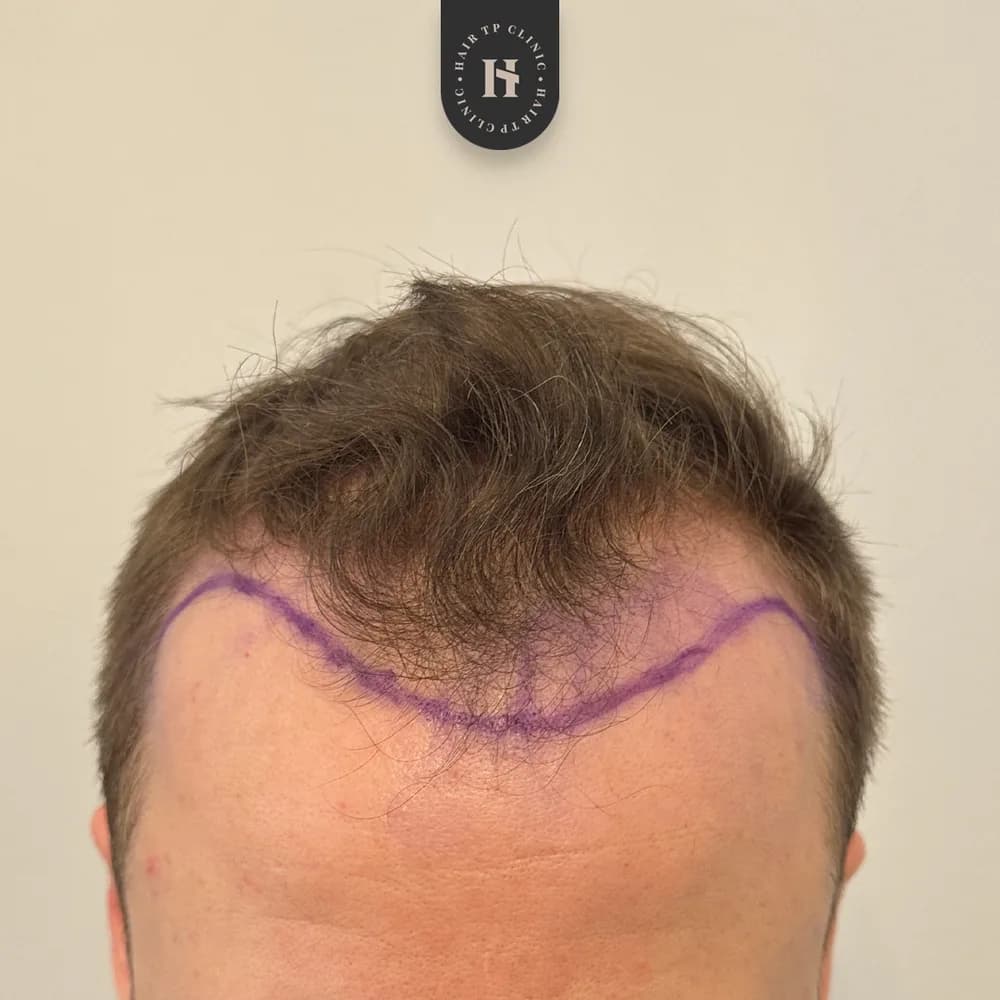 Före hårtransplantation, man