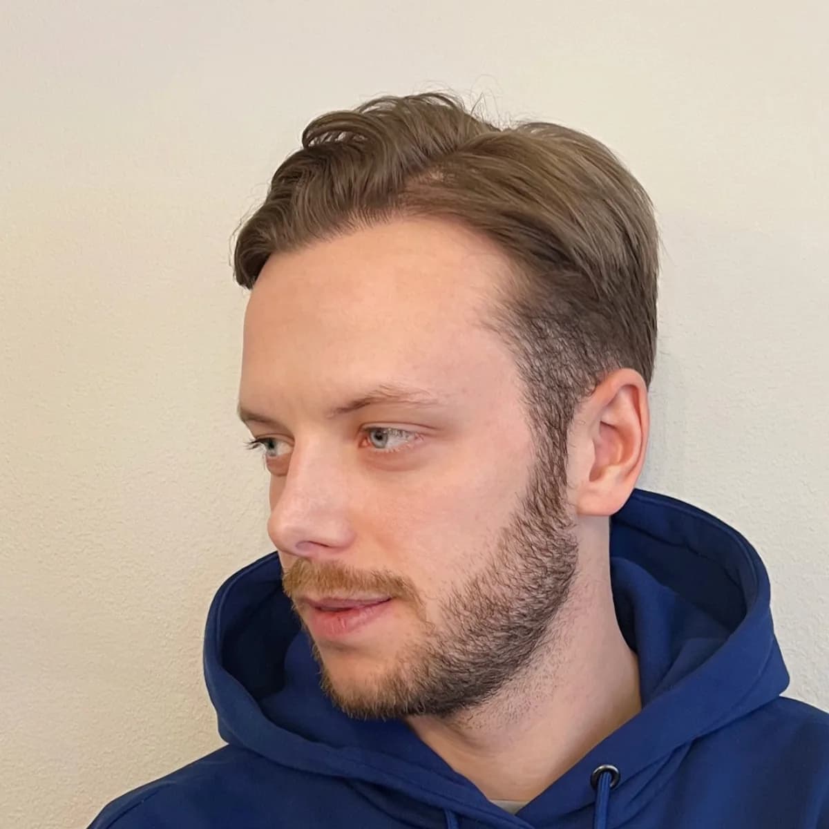 Carl Déman – efter hårtransplantation