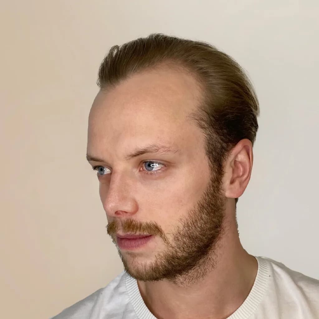Carl Déman – före hårtransplantation