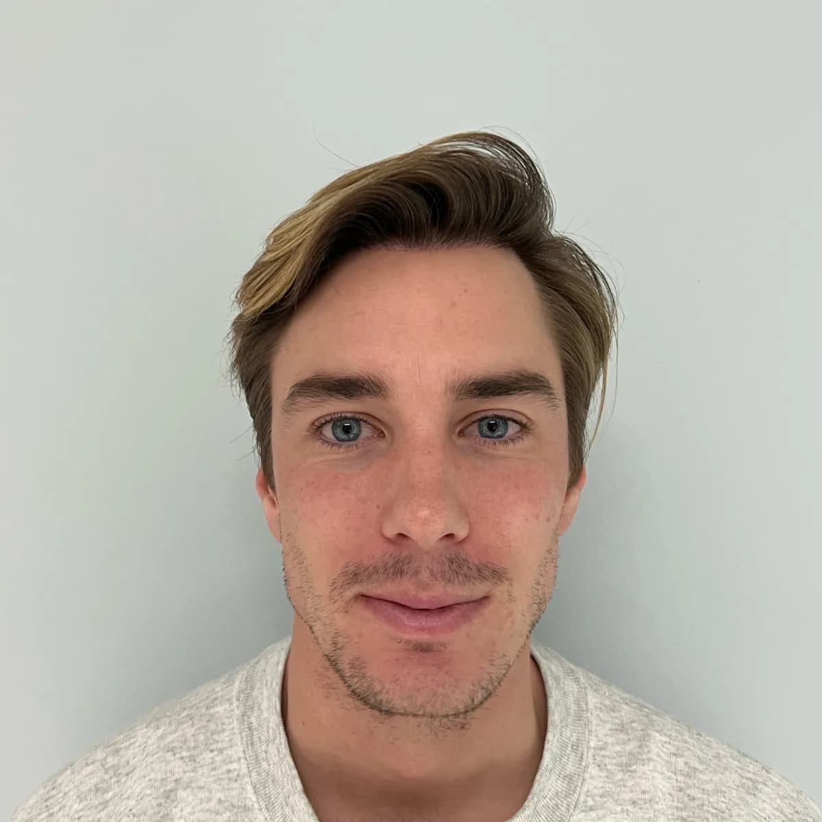Jonas Fagerström – efter hårtransplantation