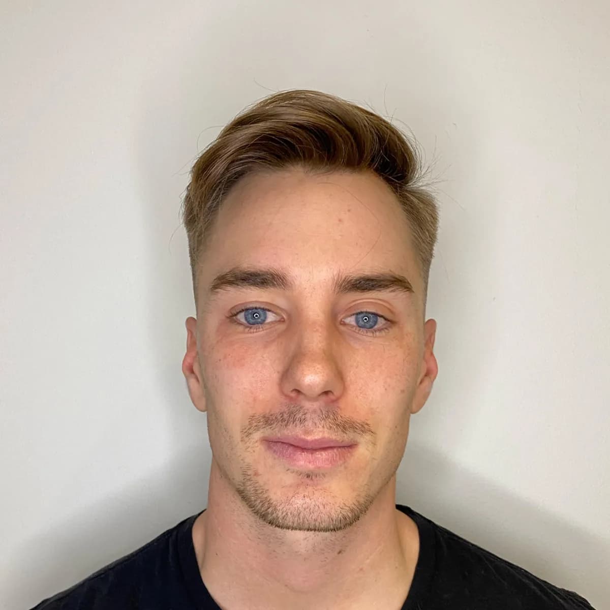 Jonas Fagerström – före hårtransplantation